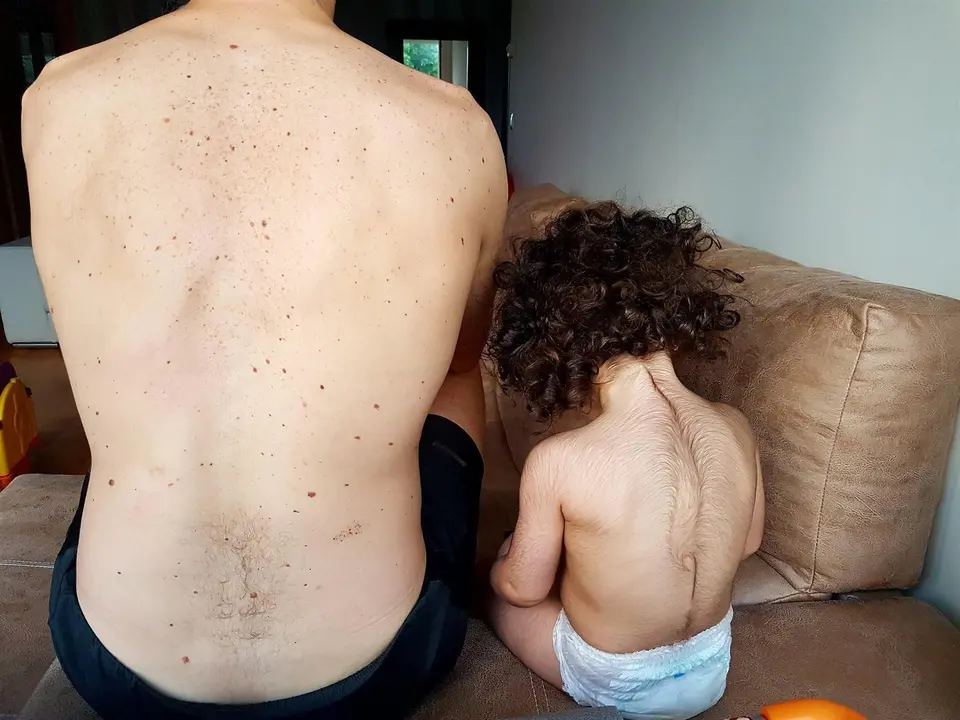 Beb&eacute; afectado de hipertricosis -exceso de bello- por haber ingerido falso omeprazol