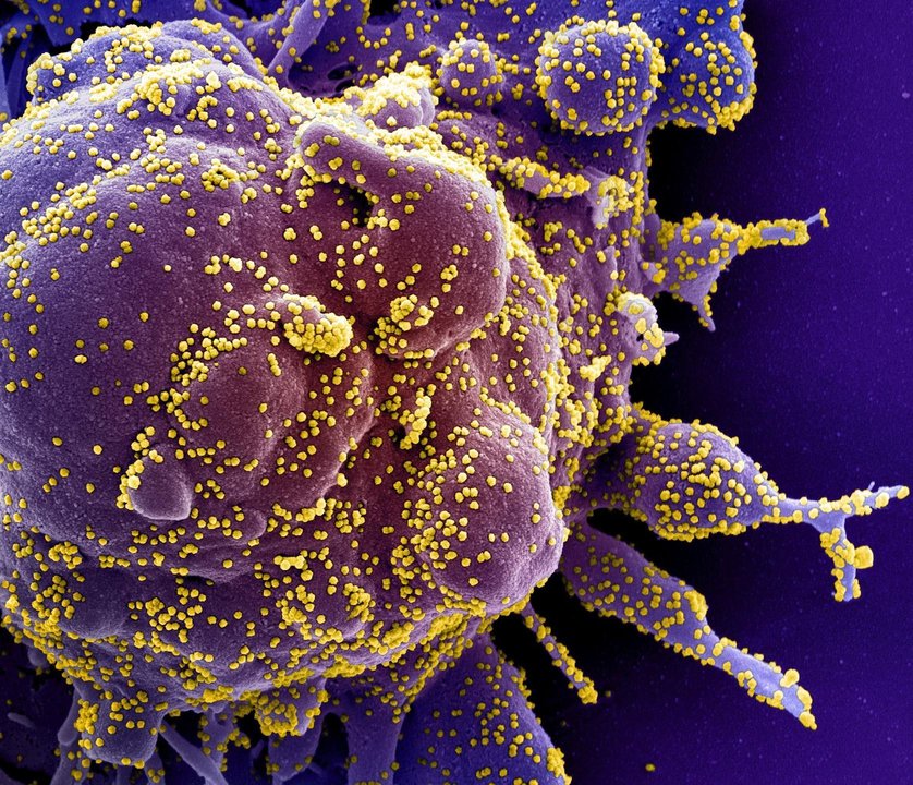 Micrografía electrónica de barrido coloreada de una célula apoptótica, en morado, infectada con partículas del virus SARS-COV-2, en color amarillo, aislada de una muestra de paciente