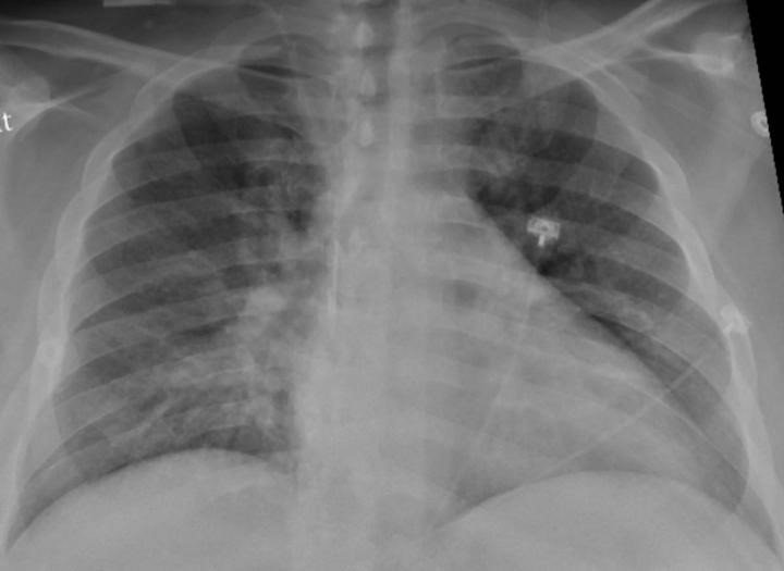 La radiografía de tórax de un paciente positivo de COVID-19 que muestra una neumonía en la parte inferior de los pulmones.
