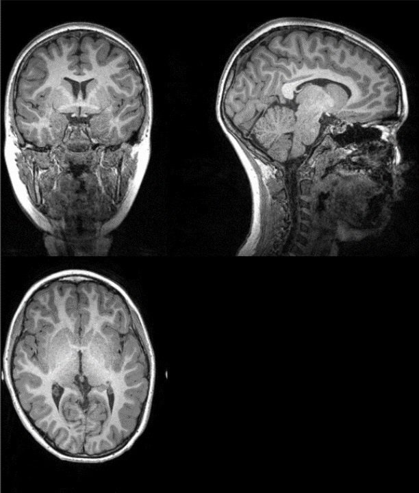 Archivo - Ejemplo de imagen original de la resonancia magnética a partir de la cual investigadores de la UGR han extraído la cantidad total de materia gris, materia blanca, y cantidad total cerebral