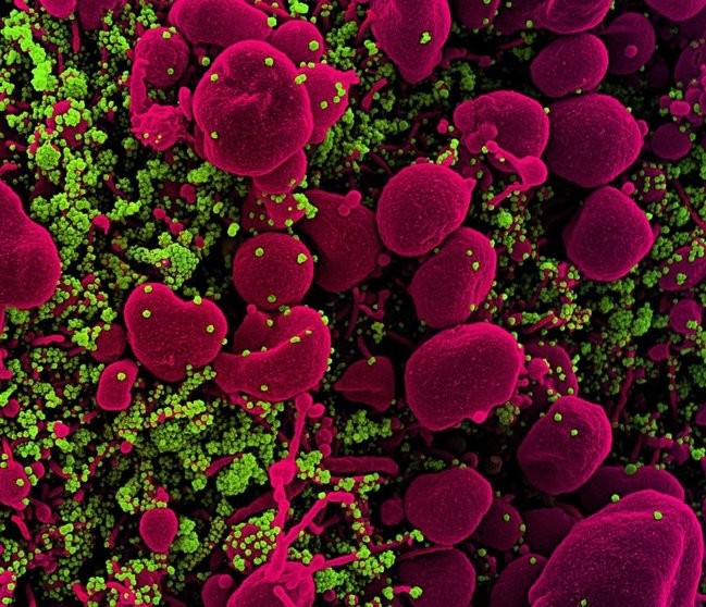 Archivo - Micrografía electrónica de barrido coloreada de una célula apoptótica (rosa) muy infectada con partículas del virus SARS-COV-2 (verde), aislada de una muestra de un paciente.