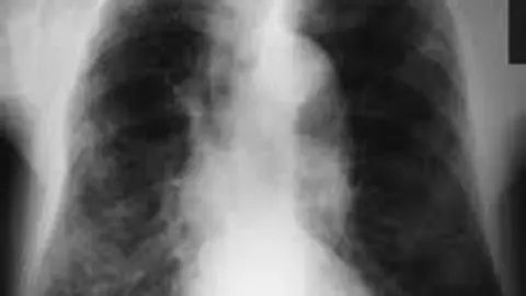 Pulmones en una imagen de archivo