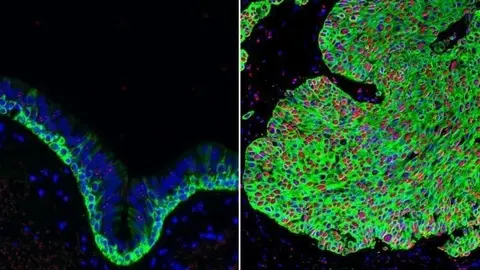 Tejido normal de las v&iacute;as respiratorias (izquierda) y tejido canceroso del pulm&oacute;n (derecha), con una sobreabundancia de c&eacute;lulas madre basales (verde). La forma activada de beta-catenina (rojo) en el c&aacute;ncer de pulm&oacute;n puede ser atacada por el compuesto