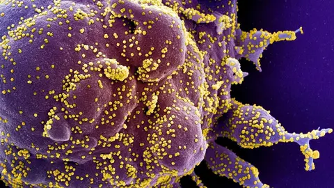 Micrograf&iacute;a electr&oacute;nica de barrido coloreada de una c&eacute;lula apopt&oacute;tica, en morado, infectada con part&iacute;culas del virus SARS-COV-2, en color amarillo, aislada de una muestra de paciente