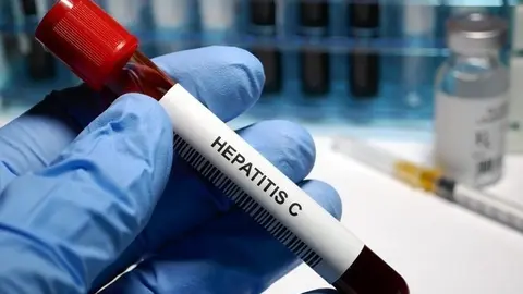 Hepatitis C treatment  Hepatitis C - sexually transmitted disease blood test and treatment