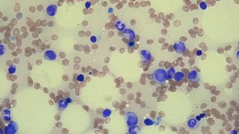 Imagen de m&eacute;dula &oacute;sea sana.