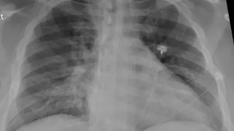 La radiograf&iacute;a de t&oacute;rax de un paciente positivo de COVID-19 que muestra una neumon&iacute;a en la parte inferior de los pulmones.